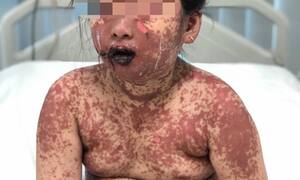 Sử dụng thuốc bừa bãi, trẻ bị dị ứng nguy hiểm tính mạng