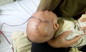 Ngã từ trên giuờng xuống, bé trai 9 tháng tuổi bị lún sọ não