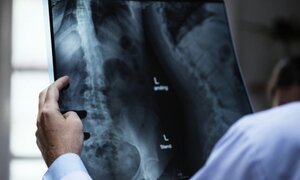 Một phần xương cánh tay của người phụ nữ biến mất đầy bí ẩn