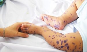 3 triệu chứng báo hiệu bệnh tay chân miệng không thể xem thường