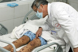 Viêm màng não do nhiễm khuẩn não mô cầu: Căn bệnh nguy hiểm chết người