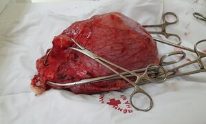 Khối u xơ tử cung nặng gần bằng một em bé sơ sinh hành hạ người phụ nữ khốn khổ