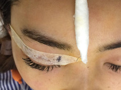 Bác sĩ vã mồ hôi với ca mổ thẩm mỹ ‘bỏ quên’ kim trong mắt