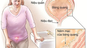 7 dấu hiệu cảnh báo bạn cần phải đi khám bàng quang trước khi quá muộn