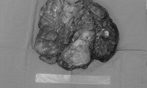 Cứu bệnh nhân có khối u mạc treo nặng hơn 10kg