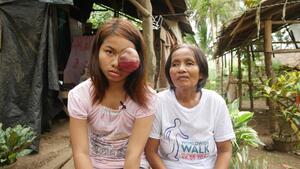 Nuôi tóc dài che nửa khuôn mặt, cô gái đáng thương dấu diếm khối u sưng phồng một bên mắt