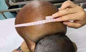 Đeo khối u nặng 15kg suốt 47 năm sau gáy, người đàn ông khốn khổ 'sống không bằng chết'