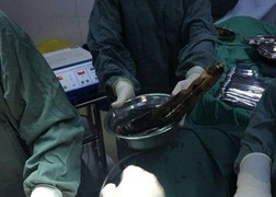 Nhét cà tím vào hậu môn để tự chữa táo bón, người đàn ông nhập viện