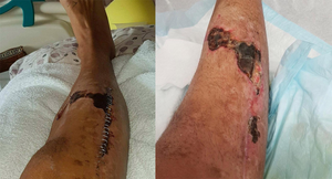 Suýt chết vì nhiễm virus ăn thịt người từ chiếc đinh gỉ sét
