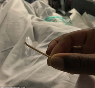 Người phụ nữ vật lộn khi que tránh thai ‘đi lạc’ tới tim, tắc động mạch phổi