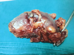 Vật lộn loại bỏ khối u đại tràng cho cụ ông 76 tuổi