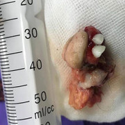 Khối u quái có răng, tóc, xương trong buồng trứng bé gái