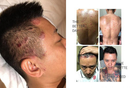 Bệnh vẩy nến mà ca sĩ Tuấn Hưng mắc phải nguy hiểm thế nào?