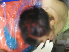 Gặp tai nạn, cả xe máy cả người lái nằm trong vệ bờ ao, bất tỉnh chấn thương sọ não