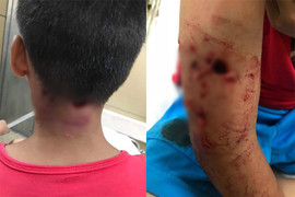 Thêm một bé trai bị chó cắn thủng tay và gáy khi cho chó ăn