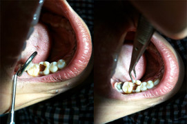 Rùng mình chiếc răng rỗng tuếch, vỡ đôi trong miệng bệnh nhân