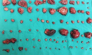 Xem bóc hàng trăm khối u ung thư từ ổ bụng người đàn ông 51 tuổi