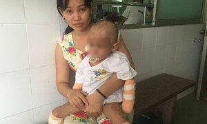 Hoại tử, thối thịt, tội nghiệp bé 2 tuổi phải cắt tứ chi
