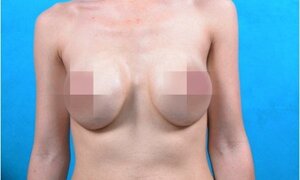 'Hãi hùng' những bộ ngực dị dạng, xập xệ không tưởng sau nâng cấp