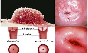 Căn bệnh ung thư 2 phút có người chết sẽ được họp bàn trong APEC 2017
