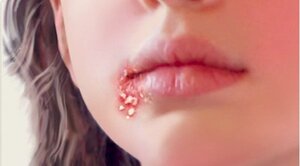 4 căn bệnh lây nhiễm qua đường tình dục ít người ngờ tới