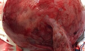 Phẫu thuật lấy thai cho sản phụ có khối u xơ tử cung nặng 2,8kg