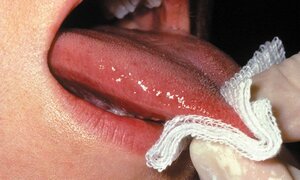 15 dấu hiệu cảnh báo ung thư, nhiều người nhầm là bệnh vặt