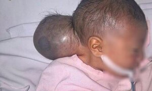 Thương tâm bé gái bị bỏ rơi có khối u to như đầu