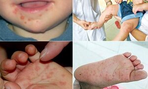 Hơn 43 nghìn ca mắc tay chân miệng, Bộ Y tế ra cảnh báo