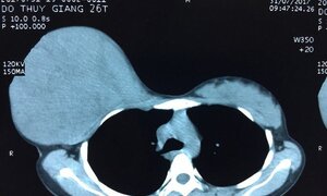 Xúc động người mẹ trì hoãn phẫu thuật khối u tuyến vú 'khủng' để sinh con