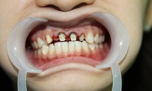 Chi phí rẻ, khách Tây bay sang Việt Nam làm răng