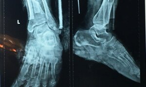 Sơ ý, cụ ông bị máy cắt cỏ cắt gần lìa cẳng chân