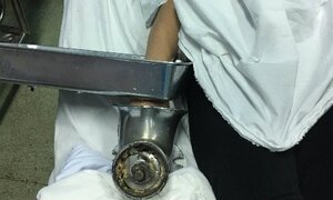 Cấp cứu bệnh nhân bàn tay dập nát vì bị cuốn vào máy xay thịt