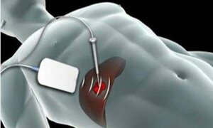 Lần đầu cắt u gan không cần mở ổ bụng