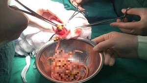Hoảng hồn phát hiện búi giun đũa gây tắc ruột bé 3 tuổi
