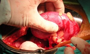 Hai ca ghép thận không cùng huyết thống thành công tại Bệnh viện Xanh Pôn