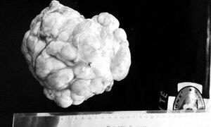 Cứu bé 3 tuổi có khối u nặng 3kg, choán gần hết ổ bụng