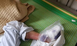Nỗi ám ảnh của bệnh nhân tiểu đường khi phải cắt chân