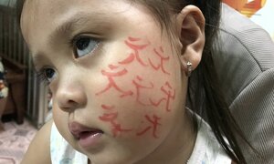 Bé gái nhập viện cấp cứu vì để thầy cúng vẽ bùa lên mặt chữa bệnh