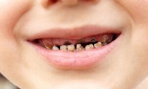7 loại thực phẩm khiến răng bạn mủn yếu dễ sâu 'thủng lỗ chỗ'