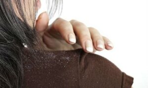 Không phải do ở bẩn - 5 điều này cũng khiến đầu của bạn phủ đầy gàu