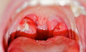 Những biến chứng nguy hiểm khi trẻ bị viêm mũi họng