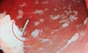 Gắp cây kim dài 2,5 cm trong bụng nam công nhân