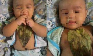 Bé gái bỏng ngực nặng vì trị sổ mũi bằng lá trầu
