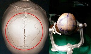 Nữ giáo sư hàng đầu thế giới đến Việt Nam mổ phình mạch não