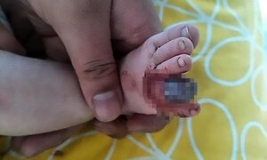 Bé trai nguy cơ mất ngón chân vì một sợi tóc