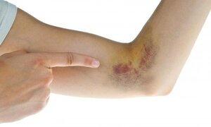 Khi xuất hiện 4 dấu hiệu này, hãy coi chừng bạn mắc ung thư