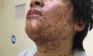 Cô gái bị biến dạng khuôn mặt vì tự ý dùng thuốc kháng sinh