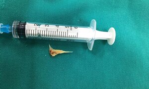 Xương cá nằm trong khí quản bệnh nhân suốt 2 tuần