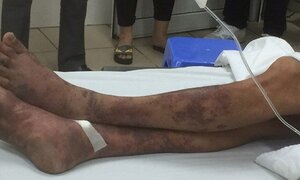 Giết lợn phục vụ đám cưới, ông lão nhiễm căn bệnh chết người